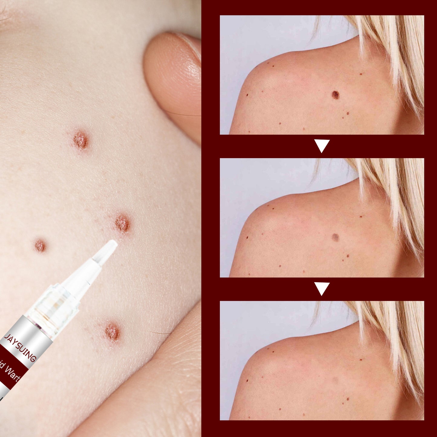 đ„Last Day Promotion 65% OFFđ„Tags & Moles Remover