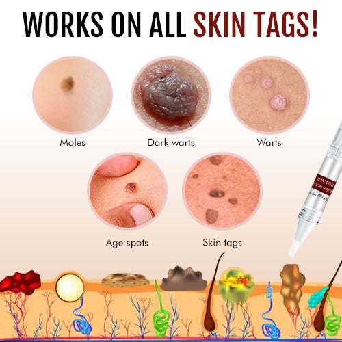 đ„Last Day Promotion 65% OFFđ„Tags & Moles Remover