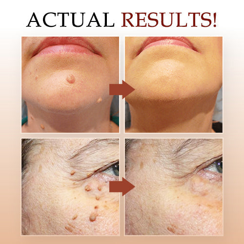 đ„Last Day Promotion 65% OFFđ„Tags & Moles Remover